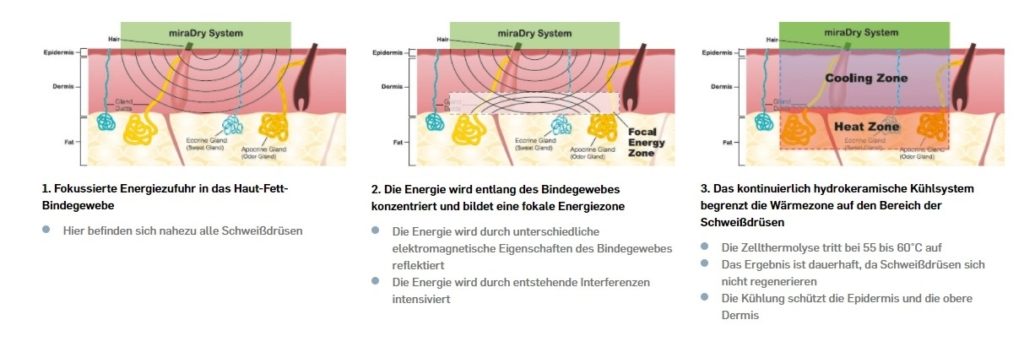 miradry behandlung hyperhidrose