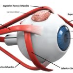 Ein Augenlid ist eine dünne Hautschicht, die das Auge bedeckt und schützt. Das Auge enthält einen Muskel, der das Augenlid zurückzieht, um das Auge entweder freiwillig oder unwillkürlich zu öffnen. Augenlider des Menschen enthalten eine Reihe von Wimpern, die das Auge vor Staubpartikeln, Fremdkörpern und Schweiß schützen. Hauptfunktionen des Augenlids Eine der Hauptfunktionen des Augenlids ist es, das Auge zu schützen und Fremdkörper fernzuhalten. Eine weitere wichtige Funktion des Augenlids ist es, regelmäßig Tränen auf der Oberfläche des Auges zu verteilen, um es feucht zu halten. Bei jedem Blinzeln gibt es einen leichten Pump- oder Quetschmechanismus, der Tränen über das Auge ausdrückt. Außerdem gibt es eine leichte horizontale Bewegung, die die Tränen in Richtung der puncta, des Abflussrohrs für die Tränen drückt, damit sie ordnungsgemäß entsorgt und entwässert werden kann. Augenliddrüsen Das Augenlid enthält verschiedene Arten von Drüsen einschließlich Talgdrüsen, Schweißdrüsen, Tränendrüsen und Meibom-Drüsen . Tränendrüsen, die uns jeden Tag schmierende Tränen geben, sind klein und befinden sich überall im Deckel. Die Tränendrüse, die sich unter dem oberen Augenlid und unter der Körperbahn befindet, sondert Reflextränen ab. Die Tränendrüse sondert Tränen ab, die entstehen, wenn wir emotional weinen oder wenn wir etwas in unser Auge bekommen. Die Tränendrüse versucht, den Schutt wegzuspülen. Augenlidmuskeln Es gibt mehrere Muskeln oder Muskelgruppen, die unsere Augenlidfunktion kontrollieren. Die Muskeln, die uns helfen zu blinken und zu funktionieren, um unser oberes Augenlid in einer normalen Position zu halten, sind: Levator Muskel Mullers Muskel Frontalis Muskel Eine andere größere Muskelgruppe, die sogenannten Orbicularis oculi Muskeln, umgibt die Augen. Diese Muskeln funktionieren, um das Auge kraftvoll zu schließen, wenn wir unser Auge schützen wollen. Die Musculus orbicularis oculi bilden auch Gesichtsausdrücke. Allgemeine Erkrankungen des Augenlids Dermatochalasis – Dermatochalasis ist eine zusätzliche Augenlidhaut, die bei Menschen über 50 Jahren auftritt. Dermatochalasis entwickelt sich als Teil des normalen Alterungsprozesses. Es wird durch Fettprolaps oder Vorwärtsbewegung verursacht und das Augenlidgewebe verliert seinen Ton, wenn wir älter werden. Die Dermatochalasis kann so stark sein, dass sie das obere Gesichtsfeld blockiert. Eine Operation, die als Blepharoplastik bekannt ist , kann durchgeführt werden, um dieses Gewebe zu entfernen und die volle Sehfunktion wiederherzustellen. Entropium – Wenn Sie ein Entropium haben, dreht sich der untere Lidrand zur Oberfläche des Auges hin. Die Wimpern können gegen die Hornhaut und die Bindehaut reiben, was Reizung, Fremdkörpergefühl, Infektion, Narbenbildung und Geschwürbildung der Hornhaut verursacht. Die häufigste Behandlung von Entropium wird mit einer Operation korrigiert. Entropium tritt am häufigsten durch Alterung auf. Das Gewebe und die Muskeln verlieren ihren Tonus und die Haut strafft sich nicht mehr gegen das Auge. Ektropion – Ektropion ist das Gegenteil von Entropium. Das Augenlid wird sich falten oder nach außen drehen oder einfach tiefer sinken. Das Auge wird sichtbar und trocknet aus. Symptome sind Schleimausfluss, sandiges, sandiges Gefühl, Reizung und Narbenbildung. Es ist häufiger, wenn wir älter werden, da die Augenlider Haut und Muskeln Ton verlieren. Eine langjährige Gesichtslähmung kann auch Ektropium verursachen. Wenn der Lidton schwach wird, kann es einfach sein, dass sich das Augenlid nach außen dreht, wenn Sie einfach nachts über Ihr Kissen rollen. Myokymia – Myokymia ist der medizinische Ausdruck eines Augenlidzuckens. Die Haut des Augenlids bewegt sich unwillkürlich. Myokymie kann normalerweise vom Leidenden gefühlt und gesehen werden. Es wird durch extreme Müdigkeit, Stress, Ängste, verbrauchtes überschüssiges Koffein und zu viel Zeit am Computer verursacht. Ruhe und Entspannung sind in der Regel alles, was für Myokymie benötigt wird, um zu lösen. Blepharospasmus – Blepharospasmus ist die abnorme, kraftvolle Kontraktion der Augenlidmuskeln. Die genaue Ursache ist unbekannt und scheint nicht mit anderen Krankheiten in Verbindung zu stehen. Die Symptome beginnen in der Regel langsam, nehmen aber im Laufe der Zeit zu starken Kontraktionen zu, die beide Augenlider betreffen. Es wird normalerweise erfolgreich mit Botox oder Botulinumtoxin behandelt. Augenreizung. Bell-Lähmung – Bell-Lähmung ist eine Lähmung oder Schwäche der Muskeln und Gesichtsnerv auf einer Seite Ihres Gesichts. Dieser Zustand kommt plötzlich auf und wird in der Regel innerhalb von 4-6 Wochen besser, kann aber bis zu sechs Monate anhalten. Leute denken oft, dass sie einen Schlaganfall haben. Bell-Lähmung wird vermutlich durch das Herpes-Virus verursacht, die Fieberbläschen verursacht, die in Zeiten von Stress reaktivieren.