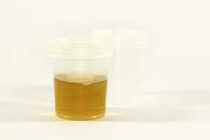 Blut-im-Urin-Hämaturie-Ursachen-Krankheiten-und-Behandlung