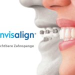 Invisalign-Unsichtbare-Zahnspange-Behandlung