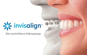 Invisalign-Unsichtbare-Zahnspange-Behandlung