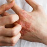 Krätze (Scabies) – Symptome, Ausschlag und Behandlung