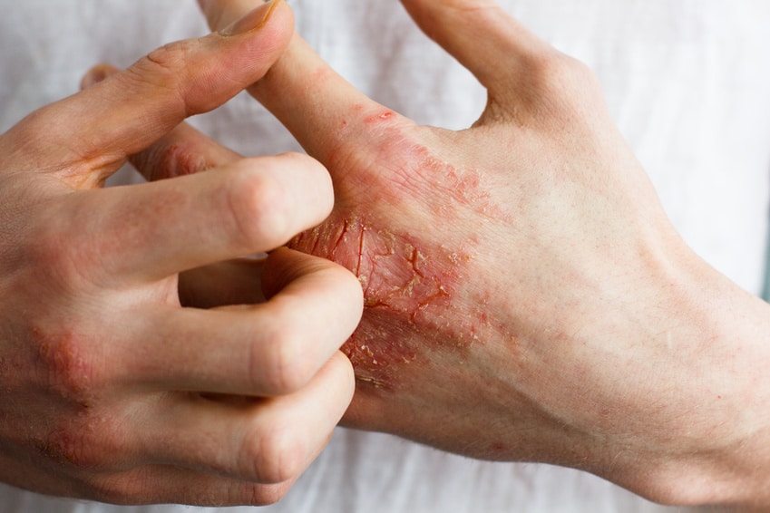 Krätze (Scabies) – Symptome, Ausschlag und Behandlung