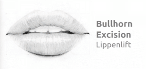 Lippenlift der Oberlippe – Bullhorn Excision