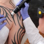 PicoSure-Tattooentfernung-Methoden-Technik