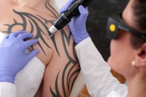 PicoSure-Tattooentfernung-Methoden-Technik