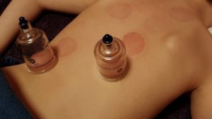Was-ist-die-Schröpftherapie-Anwendung-Vorteile-Wirkung-und-Nebenwirkung