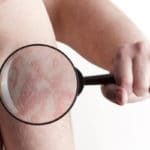 Gürtelrose - Symptome, Ursachen und Behandlung von Herpes Zoster