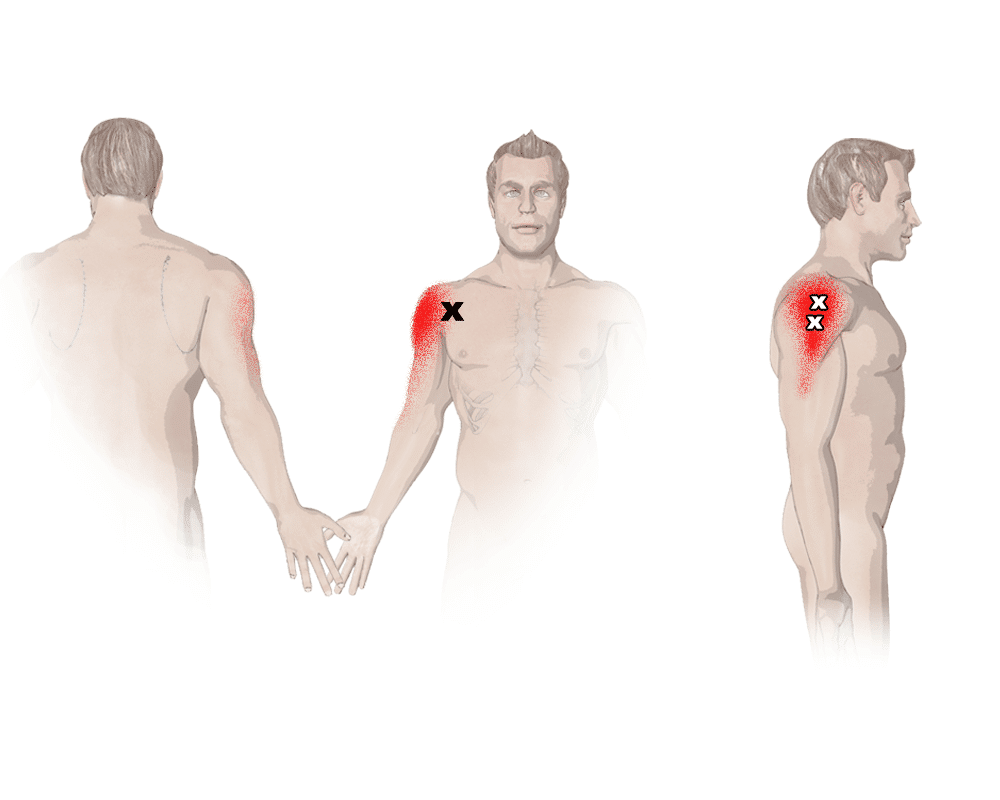 verltzung_delta_muskel_schulter_behandlung_Symptome