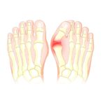 Hallux Valgus – Therapie, Operation und Risiken