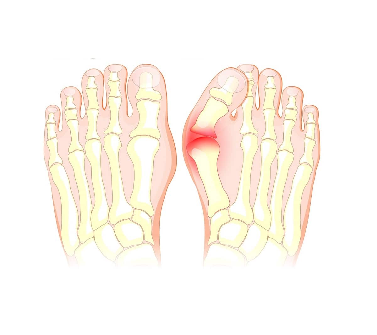 Hallux Valgus – Therapie, Operation und Risiken