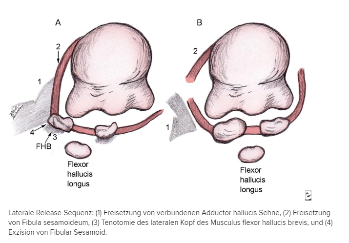 Operatives Verfahren zur Operation des Hallux Valgus