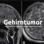 Schockdiagnose Gehirntumor: Symptome, Arten, Risiken und Behandlungsmethoden