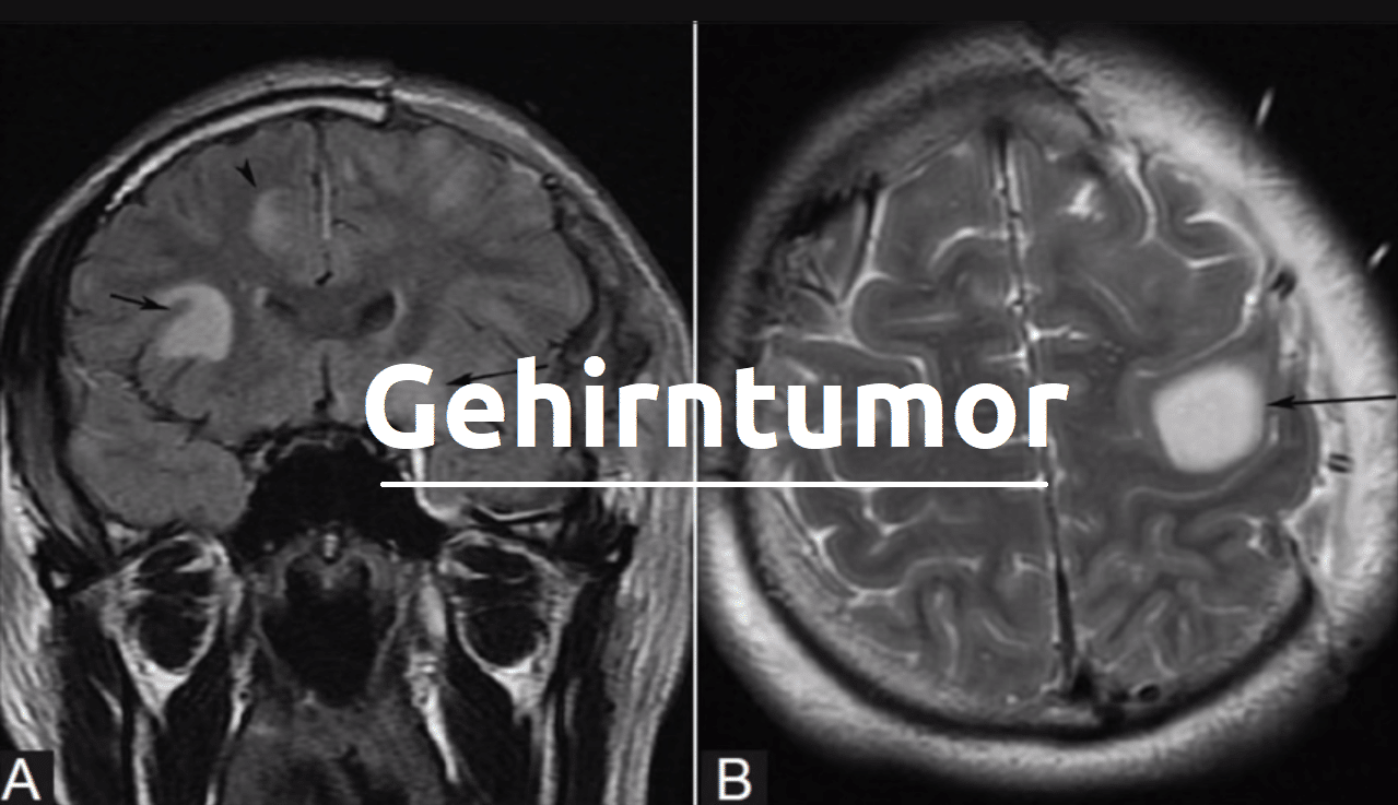 Schockdiagnose Gehirntumor: Symptome, Arten, Risiken und Behandlungsmethoden