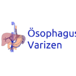 Ösophagusvarizen: Symptome, Risiken, Therapie