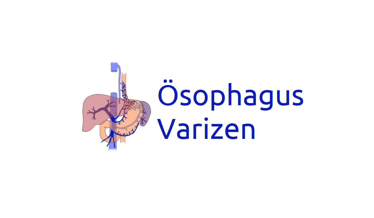 Ösophagusvarizen: Symptome, Risiken, Therapie