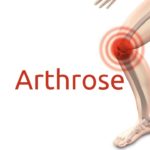 Arthrose: Symptome, Ursachen und Behandlung