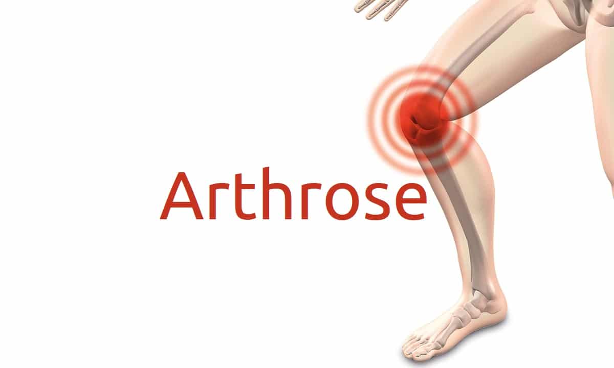 Arthrose: Symptome, Ursachen und Behandlung