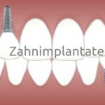 Die Vorteile von Zahnimplantaten
