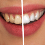 Gelbe Zähne: Ursachen, Behandlung, Hausmittel