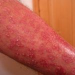 Schuppenflechte (Psoriasis) - Ursachen, Stellen, Arten, Studien und Behandlung