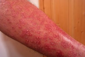 Schuppenflechte (Psoriasis) - Ursachen, Stellen, Arten, Studien und Behandlung