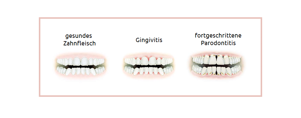 Was ist Gingivitis? Symptome, Ursachen und Behandlungen