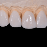 Vorteile von Veneers aus Porzellan Keramik