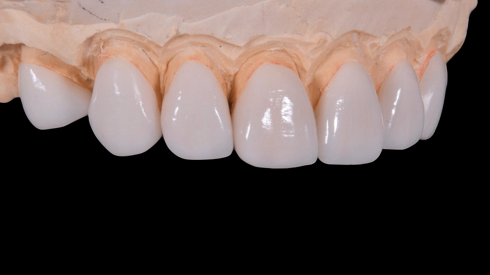 Vorteile von Veneers aus Porzellan Keramik