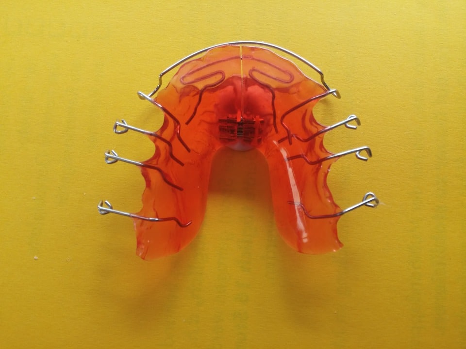 Wie lange man eine Zahnspange tragen muss