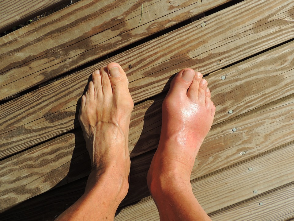 gicht_schmerzen_fuesse » Medizin - Fitness - Ernährung
