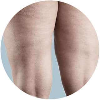 lipödem-abbildung » Medizin - Fitness - Ernährung