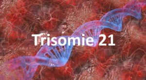 Trisomie 21 - Das Down-Syndrom