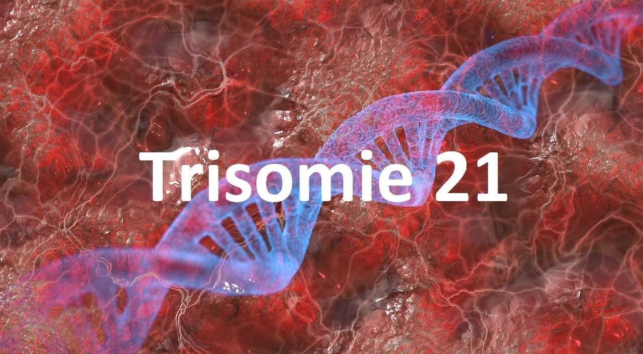 Trisomie 21 - Das Down-Syndrom