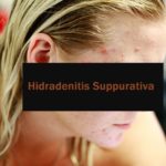 Ein Überblick über Hidradenitis Suppurativa
