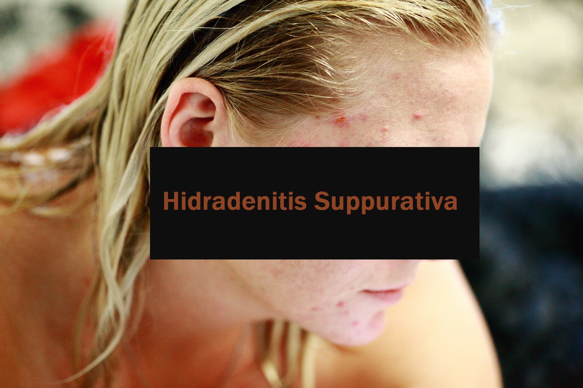 Ein Überblick über Hidradenitis Suppurativa