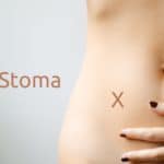 Was ist ein Stoma - Kolostomie oder Ileostomie