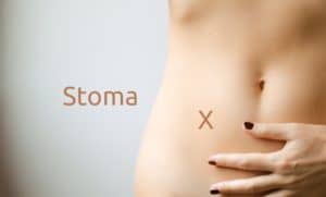 Was ist ein Stoma - Kolostomie oder Ileostomie