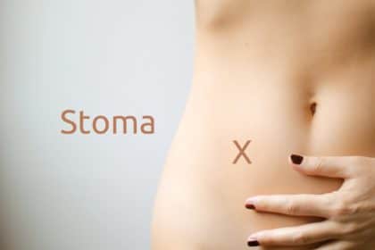 Was ist ein Stoma - Kolostomie oder Ileostomie