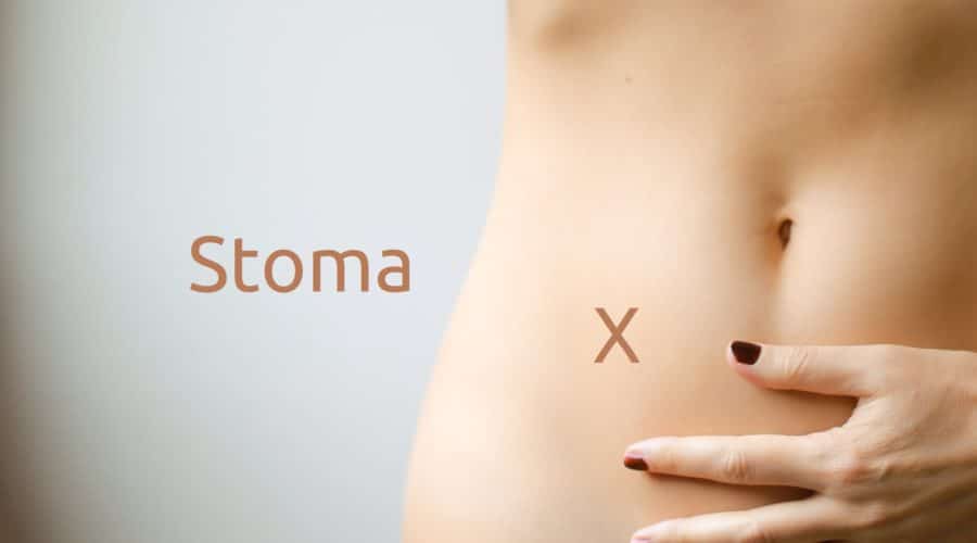 Was ist ein Stoma - Kolostomie oder Ileostomie