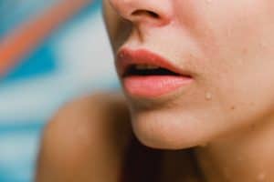 Was sind die Vorteile von Hyaluronsäure für die Lippen