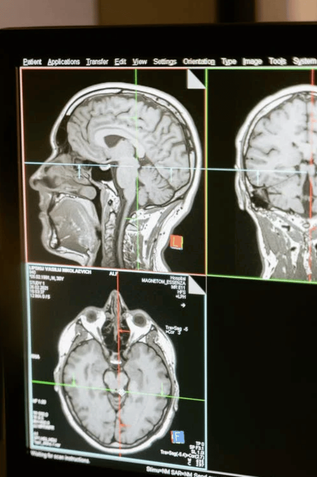 Amyotrophen Lateralsklerose - ALS Diagnose