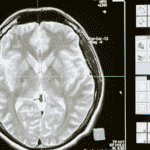 HDL („gutes“) Cholesterin kann helfen, Alzheimer vorzubeugen – Studie