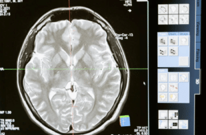 HDL („gutes“) Cholesterin kann helfen, Alzheimer vorzubeugen – Studie