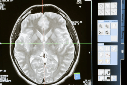 HDL („gutes“) Cholesterin kann helfen, Alzheimer vorzubeugen – Studie