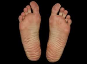 Fußgeschwür (Malum perforans) - Ursachen und Behandlung