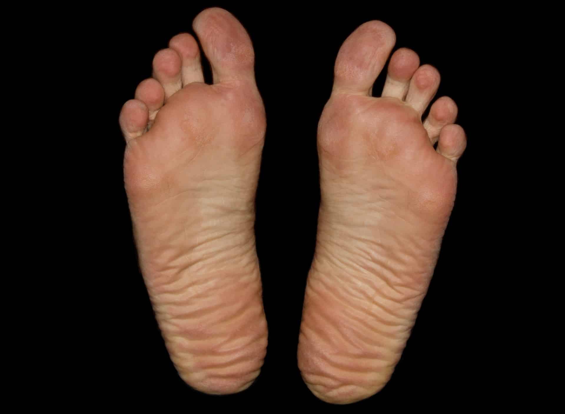 Fußgeschwür (Malum perforans) - Ursachen und Behandlung