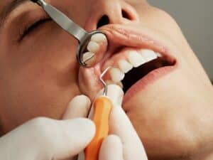 Zahnbelag und Zahnstein: Ursachen, Vorbeugung und Entfernung