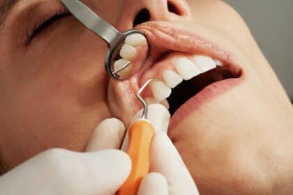 Zahnbelag und Zahnstein: Ursachen, Vorbeugung und Entfernung