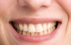 Zahnaufhellung: Methoden und Ablauf von Bleachings